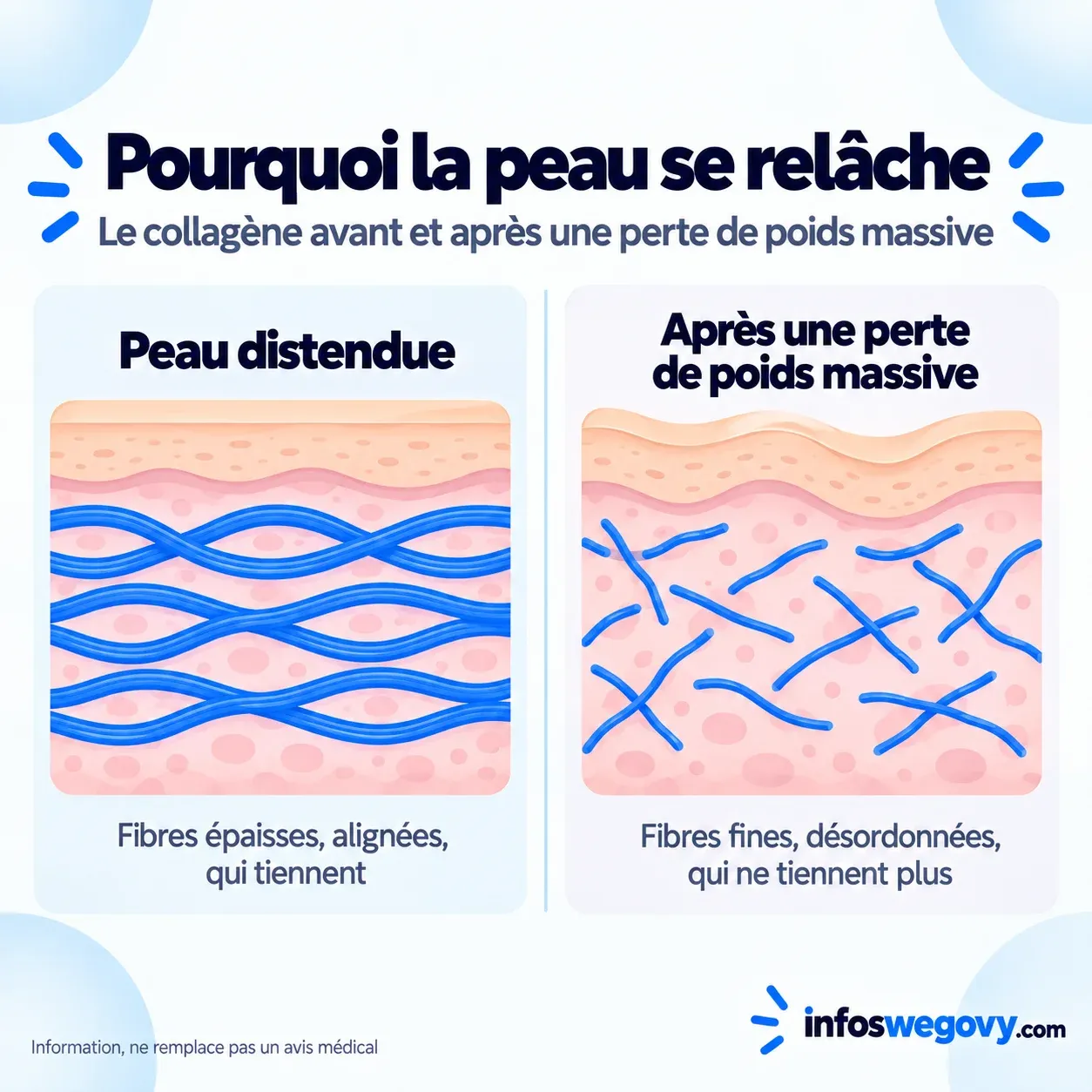 Schéma comparant les fibres de collagène épaisses d'une peau tendue et les fibres fines et désorganisées d'une peau après perte de poids massive